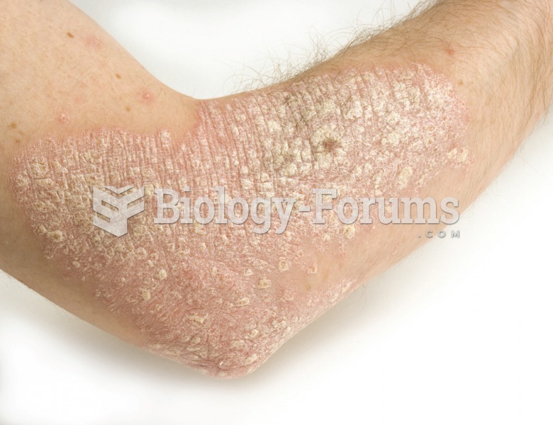 Psoriasis. This photograph demonstrates the characteristic white skin patches of this condition.