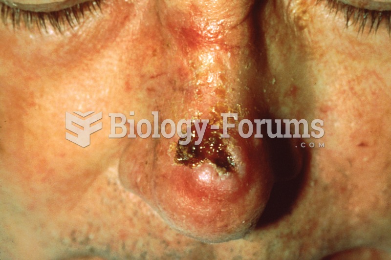Squamous cell carcinoma.