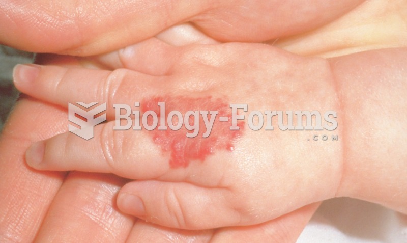 Strawberry hemangioma, a birthmark caused by a collection of blood vessels in the skin.