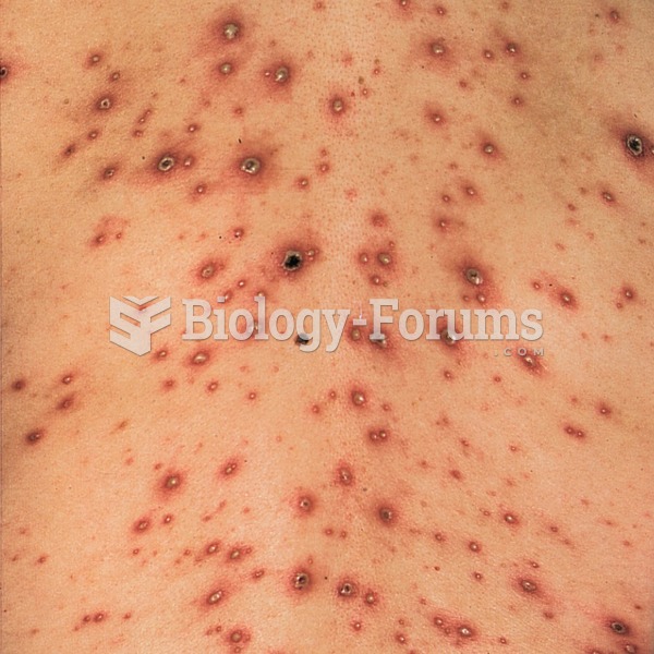 Varicella or chickenpox, a viral skin infection. In this photograph, the rash is beginning to form s