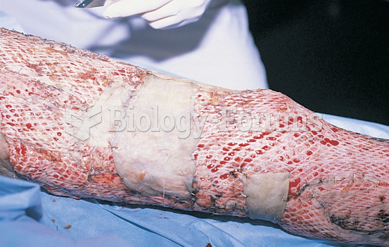 A freshly applied autograft. Note that the donor skin has been perforated so that it can be stretche