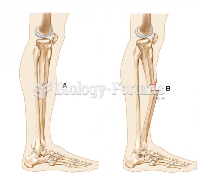 (A) Closed (or simple) fracture and (B) open (or compound) fracture. 