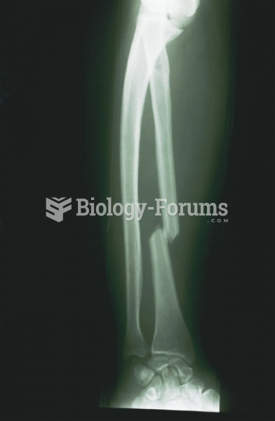 X-ray showing transverse fracture of radius.