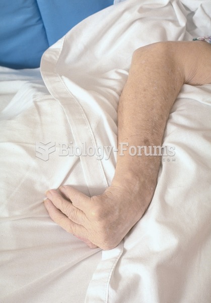 Patient with typical rheumatoid arthritis contractures. 