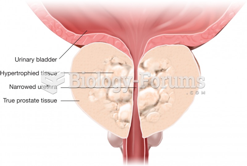 Benign prostatic hyperplasia. The condition results when an inner capsule of nonfunctional prostate 