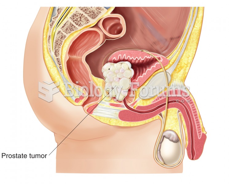 Prostate cancer. In this example, a large mass has grown into the urinary bladder. Prostate cancer i