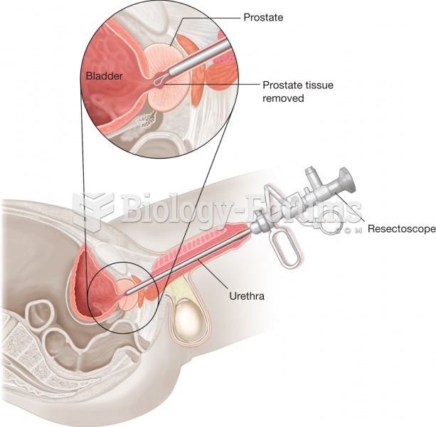 Transurethral resection of the prostate (TURP). As a treatment for BPH, part of the prostate gland i