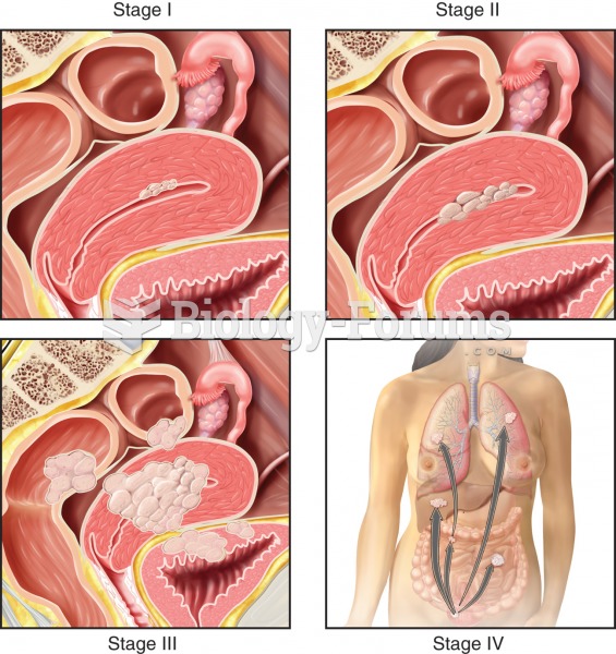 Stages of endometrial cancer. Stage I: Mutated cells arise from glandular epithelium of the endometr