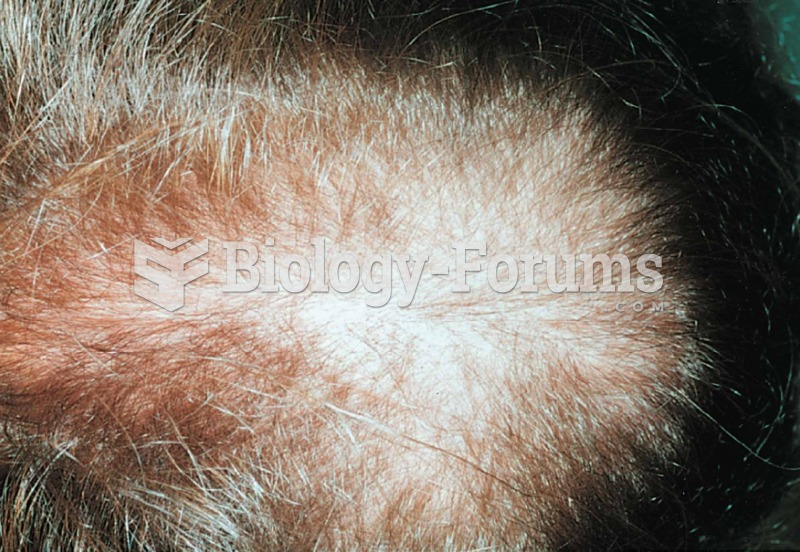 Male pattern alopecia. 