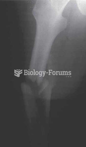 Comminuted Shatters the affected part into a multitude of bony fragments (x-ray of the femur bone)
