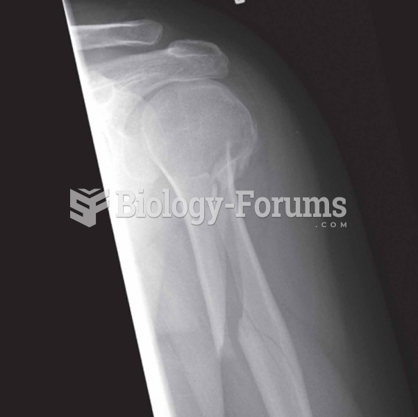 Spiral Produced by twisting stresses that are spread along the length of a bone (note the break in t