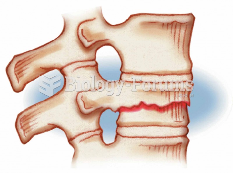 Compression Occurs in vertebrae subjected to extreme stresses, as when one falls and lands on his or