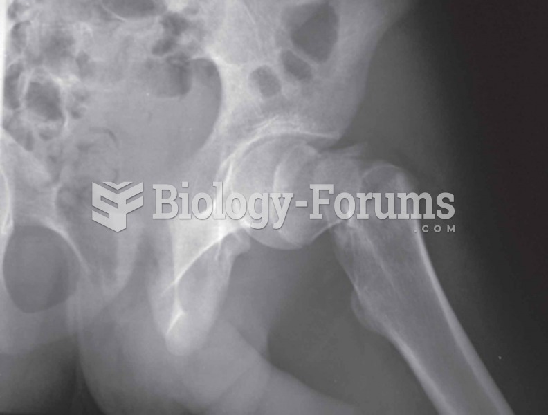 Hip Typically occurs as a result of a fall; with osteoporosis, hip fractures can occur as a result o