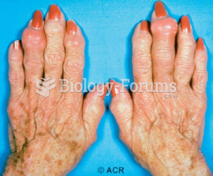 Gout of the finger joint.