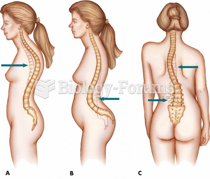 Abnormal curvatures of the spine: (A) kyphosis; (B) lordosis; and (C) scoliosis.