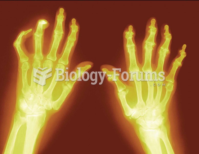 X-ray showing typical joint changes associated with osteoarthritis. 