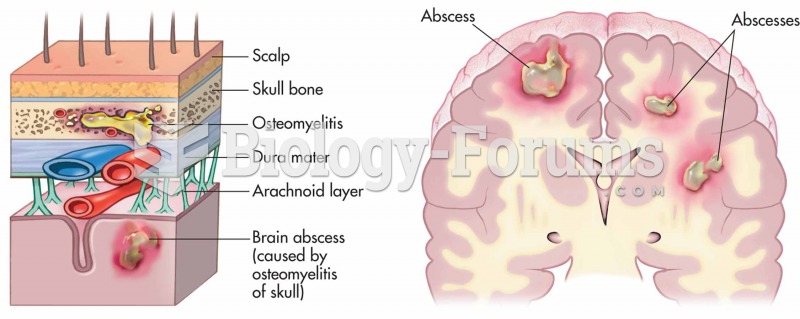 Abscess of the brain due to osteomyelitis.