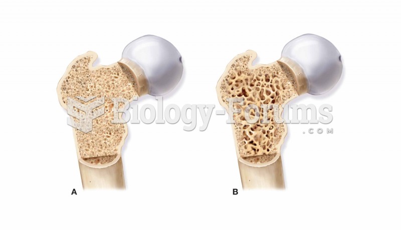 (A) Normal spongy bone. (B) Spongy bone with osteoporosis, which is characterized by a loss of bone 