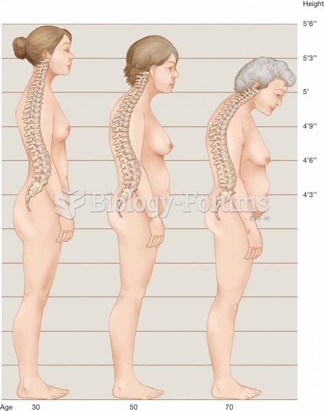 Spinal changes caused by osteoporosis.