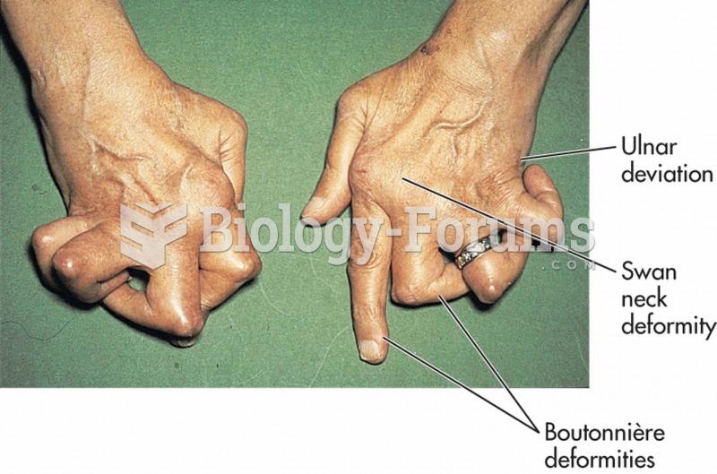 Typical hand deformities associated with rheumatoid arthritis.