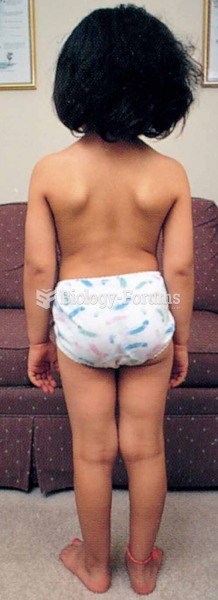 Does this child have legs of different lengths or scoliosis? Look at the level of the iliac crests a