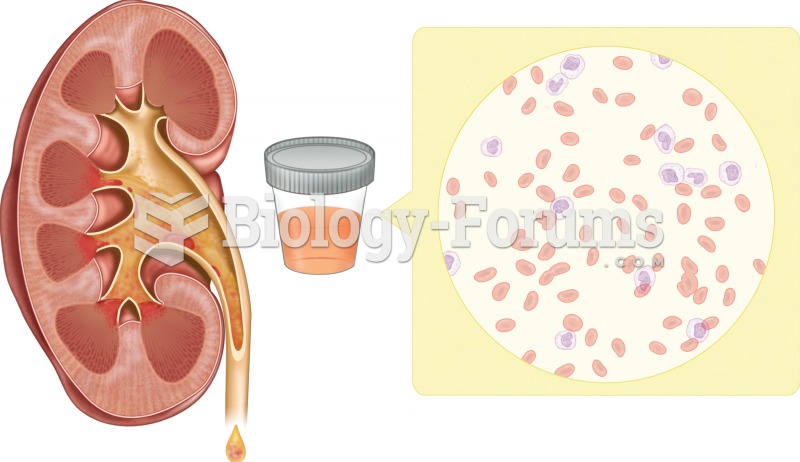 Hematuria. An analysis of urine is performed to evaluate kidney function. In this illustration, the 