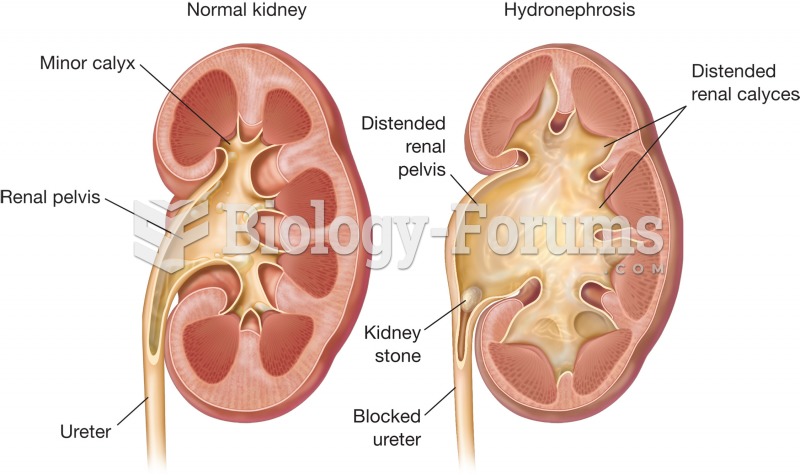 Hydronephrosis. Normal kidney (left) and kidney with hydronephrosis (right) are compared. Note the d