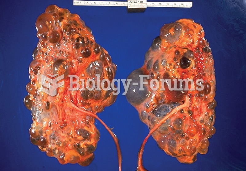 Polycystic kidney disease. Notice the presence of numerous fluid-filled sacs, or cysts, in these kid