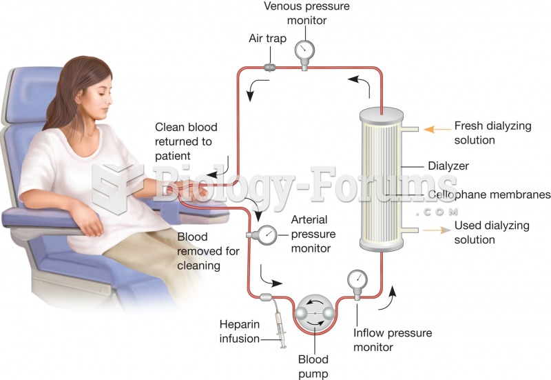Hemodialysis. The process of hemodialysis replaces the kidney function of blood filtration by forcin