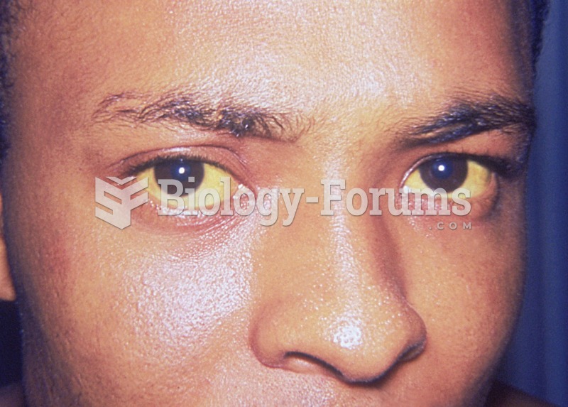 Jaundice. Photograph of an individual with liver disease, evidenced by the yellowing of the sclera o