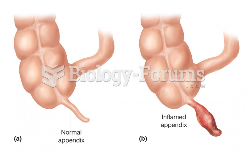 Appendicitis. (a) A normal appendix. (b) An inflamed appendix in appendicitis.  