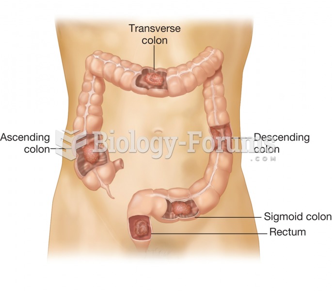 Colorectal cancer. The most common sites of tumor development are shown.  