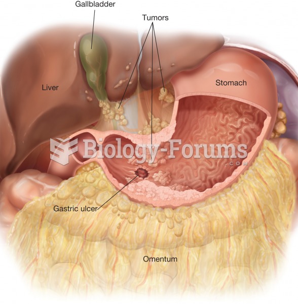 Gastric cancer. In advanced stages of gastric cancer, malignant cells spread to form tumors in the l