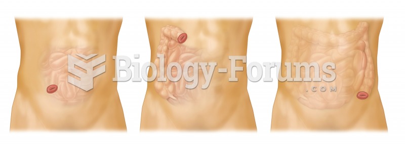 Colostomy. Alternate versions of colostomy are illustrated, each of which creates one or more new op