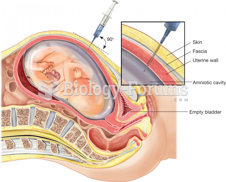 Amniocentesis. In this examination procedure, amniotic fluid is aspirated with a syringe that is ins