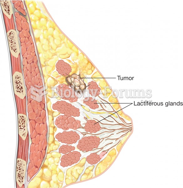 Breast cancer. Notice the tumor growing within a lactiferous gland, which occurs in infiltrating duc