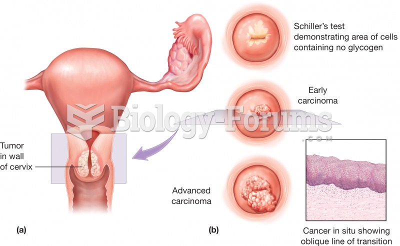 Cervical cancer (a) Top view of the uterus showing the presence of a tumor in the wall of the cervix