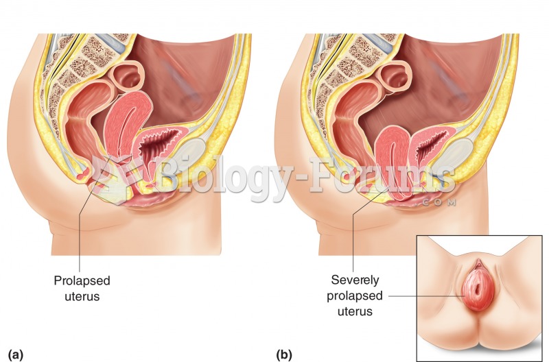 Prolapsed uterus. (a) A prolapse is the abnormal drop of the uterus into the vagina, representing th