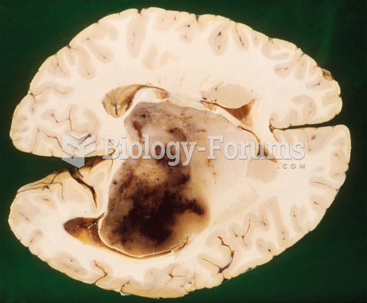 Photograph of a brain specimen with a large malignant tumor. 