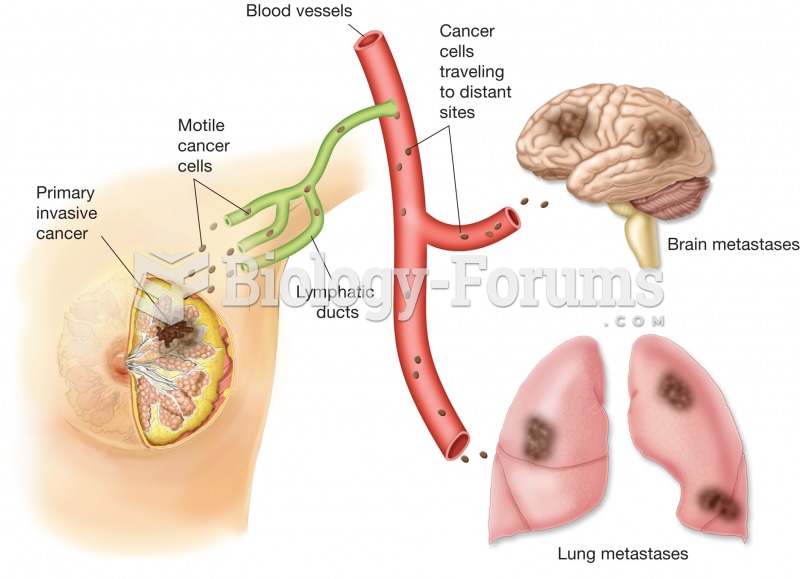 Illustration showing how the primary breast tumor metastasized through the lymphatic and blood vesse