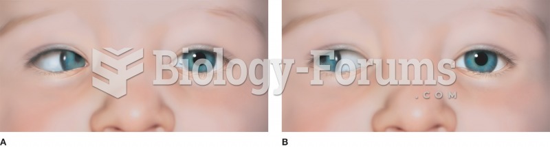 Examples of common forms of strabismus: (A) esotropia with the right eye turning inward and (B) exot