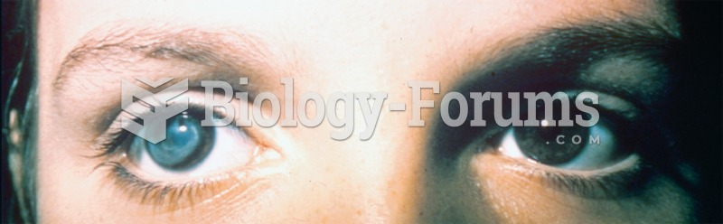 Photograph of a person with a cataract in the right eye. 