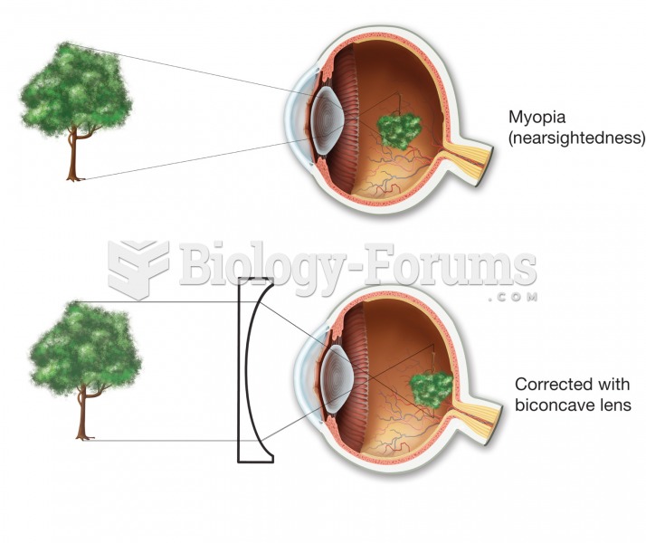 Myopia (nearsightedness). In the uncorrected top figure, the image comes into focus in front of the 