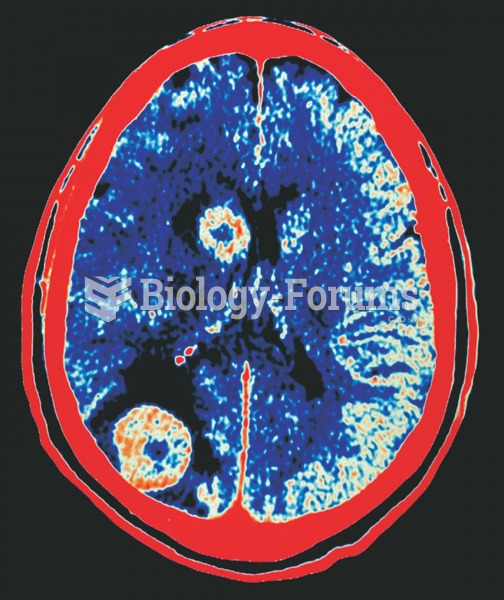 Color-enhanced CT scan showing two malignant tumors in the brain. 