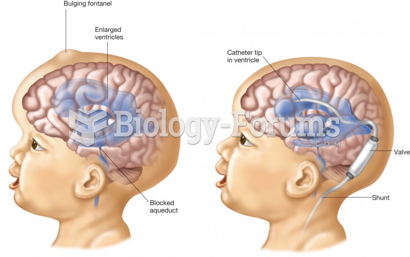 Hydrocephalus. The figure on the left is a child with the enlarged ventricles of hydrocephalus. The 