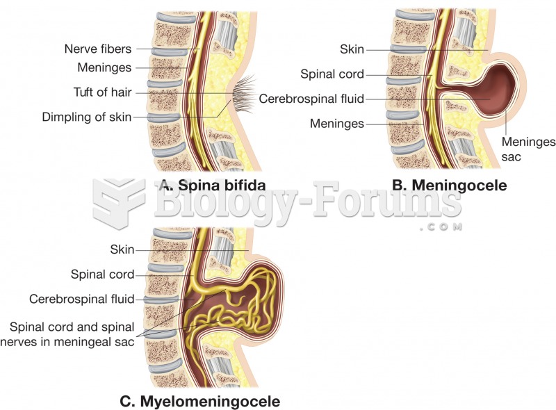 Spina bifida. (A) Spina bifica occulta; the vertebra is not complete, but there is no protrusion of 