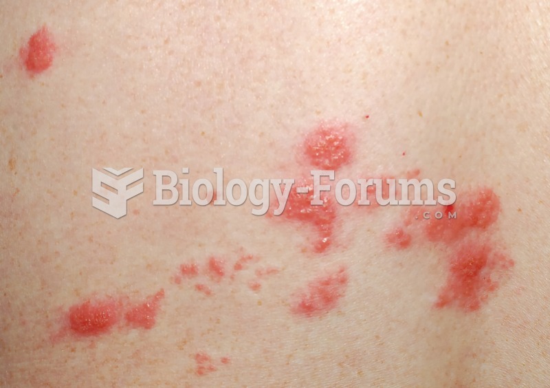 Photograph of the skin eruptions associated with shingles. 