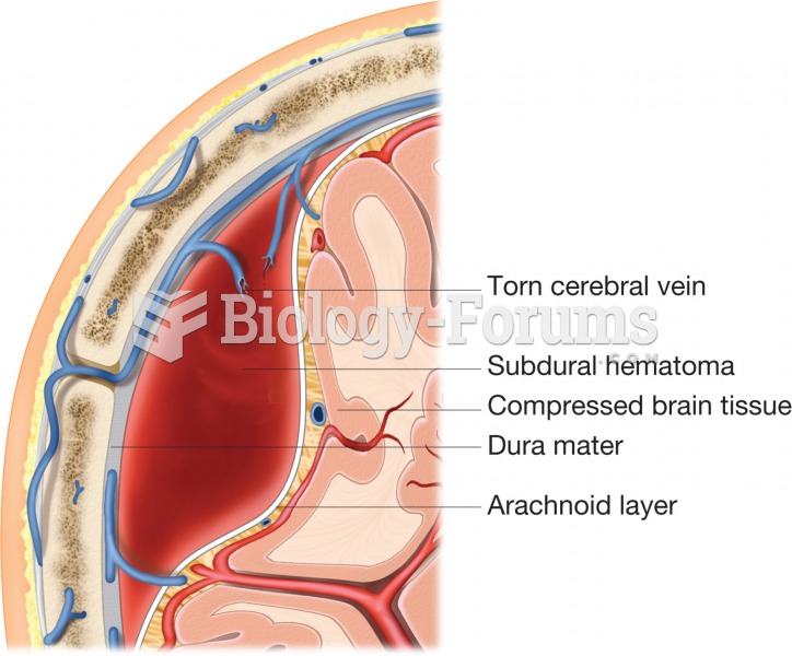 A subdural hematoma. A meningeal vein is ruptured and blood has accumulated in the subdural space, p