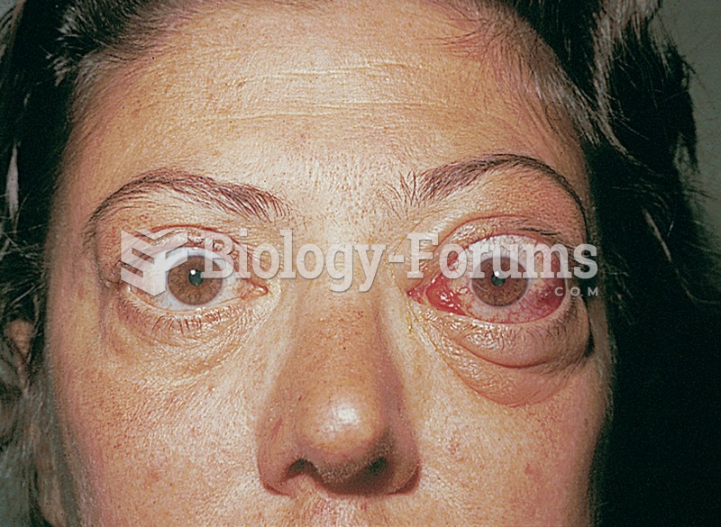 A photograph of a woman with exophthalmos. This condition is associated with hypersecretion of the t