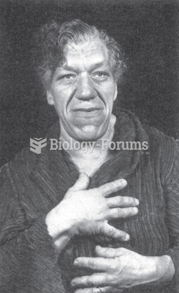 Acromegaly. Photo of a woman illustrating the enlarged skull, jaw, and hands typical of acromegaly. 